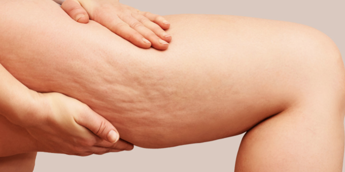 Pilates gegen Cellulite